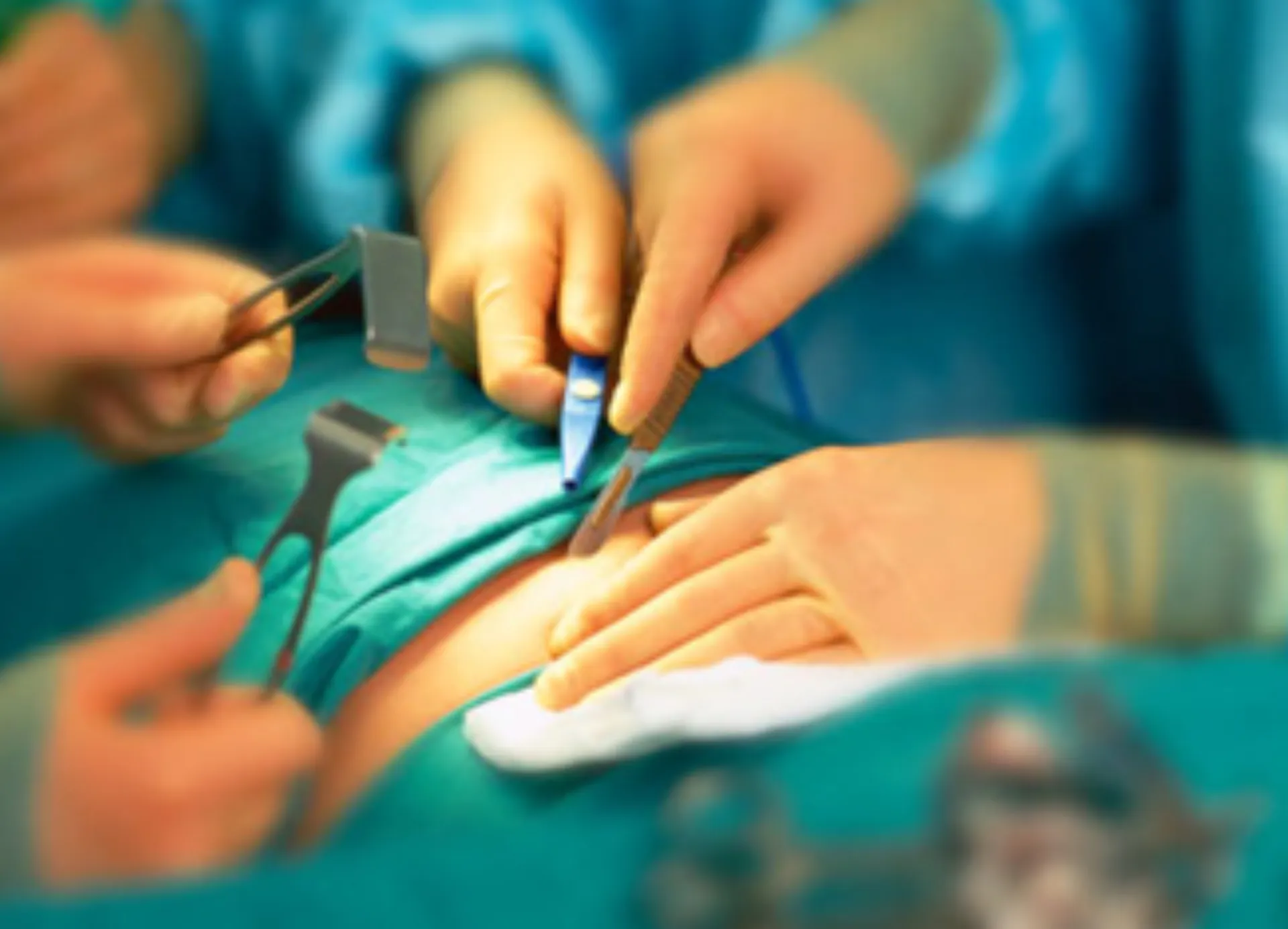 Πρωτοποριακή Επέμβαση Αφαίρεσης Ινομυώματος