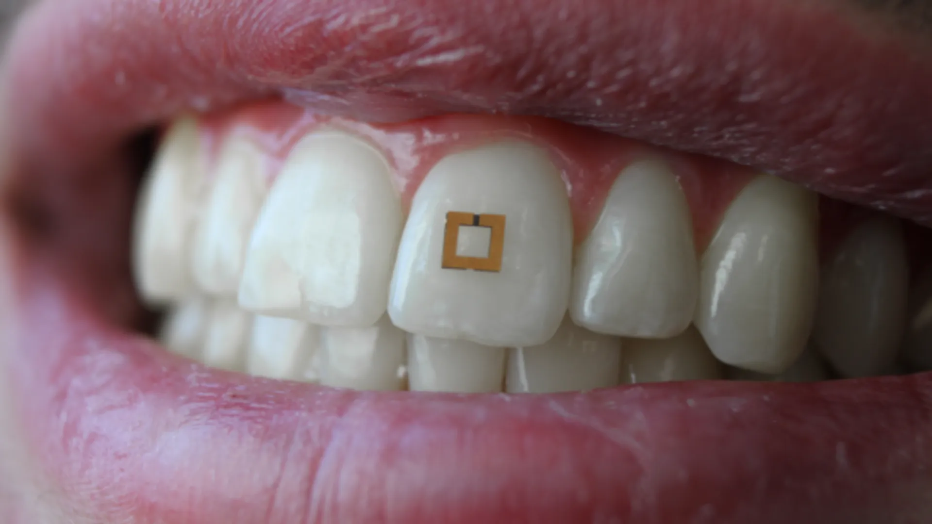 Τι μπορεί να σου δείξει ένα microchip στο δόντι σου;