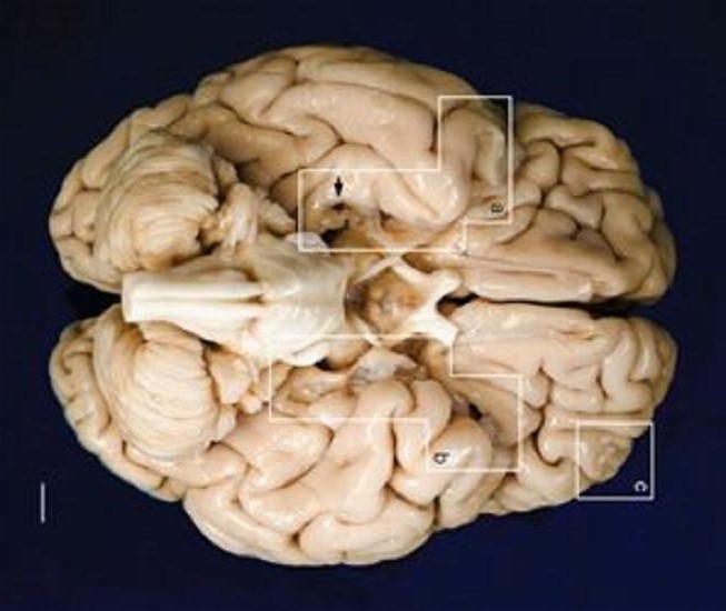 Στο Μυαλό του Ασθενή που Αποκάλυψε τους Μηχανισμούς της Μνήμης