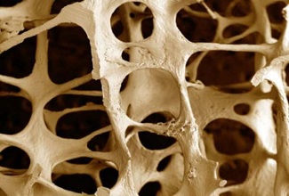 osteoporosi