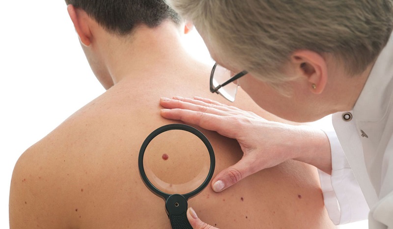 skin cancer