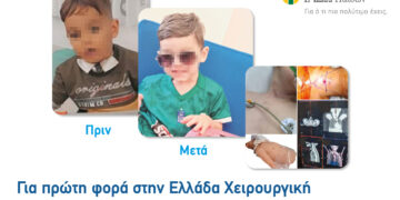 ΙΑΣΩ Παίδων: Για 1η φορά στην Ελλάδα χειρουργική αντιμετώπιση υπογλωττιδικής στένωσης τραχείας