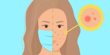 Maskne concept. Infographic vector illustration with definition of maskne - acne or irritation caused by wearing protective face mask. Female portrait, woman character with maskne closeup.