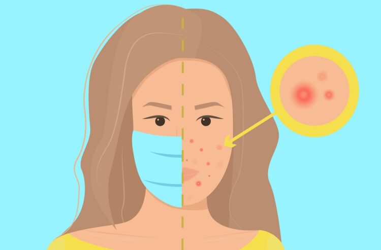 Maskne concept. Infographic vector illustration with definition of maskne - acne or irritation caused by wearing protective face mask. Female portrait, woman character with maskne closeup.