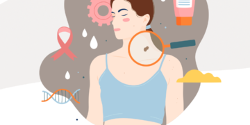 ΙΑΣΩ Γενική Κλινική: Δωρεάν Κλινική Εκτίμηση Σπίλων για την πρόληψη του καρκίνου του δέρματος