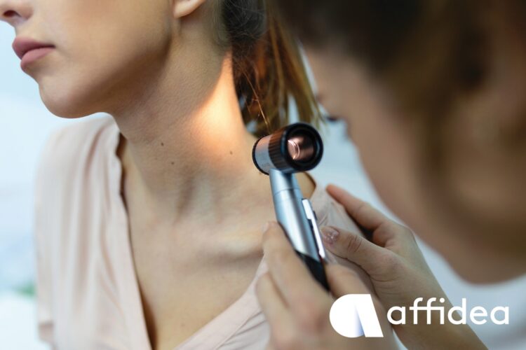 Δερματοσκόπηση σπίλων: Έγκαιρη διάγνωση του καρκίνου του δέρματος