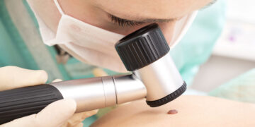 Η εξέταση-κλειδί για την έγκαιρη διάγνωση του καρκίνου του δέρματος