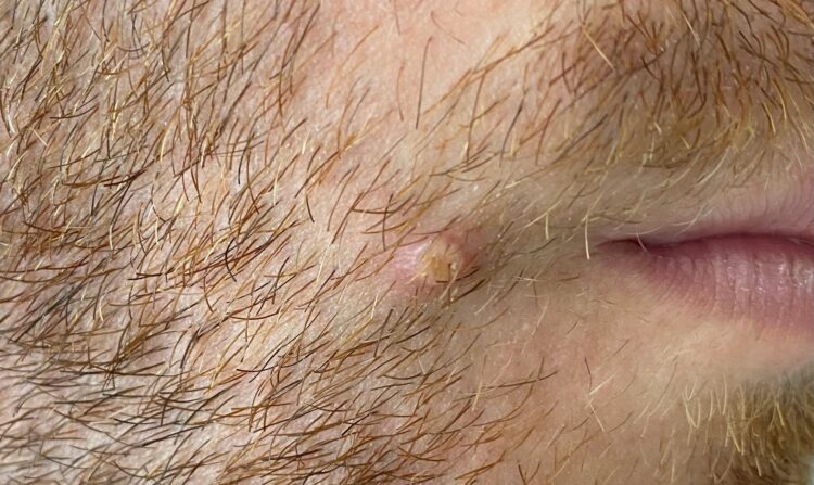 Στη Σουηδία το πρώτο ευρωπαϊκό κρούσμα Ευλογιάς των Πιθήκων